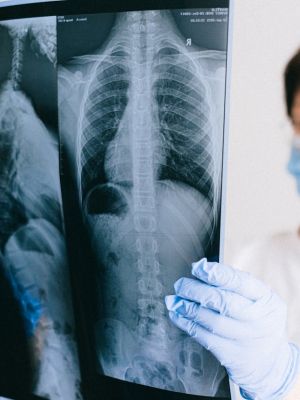 MSCT kičmenog stuba - detaljno snimanje