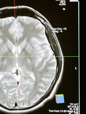 Magnetna rezonanca glave - detaljan MR pregled